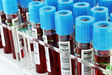 نخستین آزمایش خون برای تشخیص آلزایمر به فروش می‌رسد