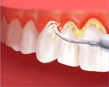 از بین بردن پلاک دندان با ۳ راهکار کاربردی