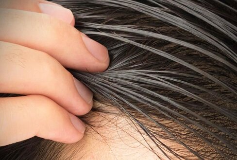 درمان چربی مو در طب سنتی + فیلم