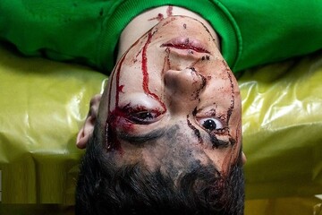 ببینید | تصاویر مصدومان چهارشنبه سوری در بیمارستان سوانح سوختگی